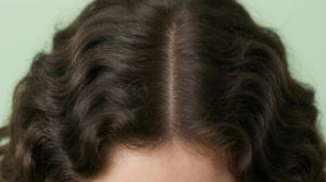 Riga dei capelli che mostra un cuoio capelluto arrossato